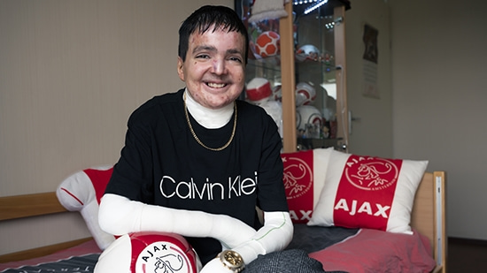 Shivan Hassan werd geboren met Epidermolysis Bullosa (EB), ook wel vlinderziekte genoemd,